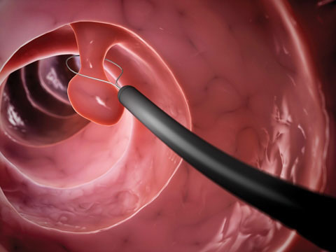 The latest advances in colonoscopy technology-omidgenetic