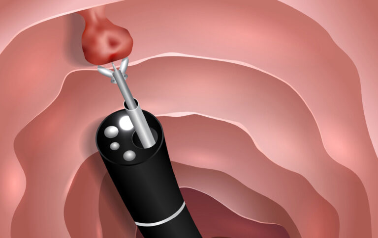 Everything About the Colonoscopy Procedure: The Complete Guide-omidgenetic