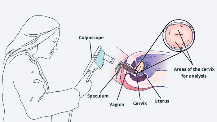 comparison-of-colposcopy-and-pap-smear-two-key-methods-in-diagnosing-cervical-problems-omidgenetic